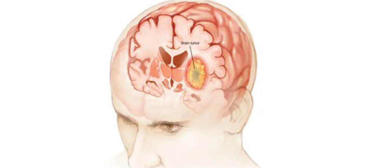 Brain Cancer: Its Causes, Symptoms, and Treatment